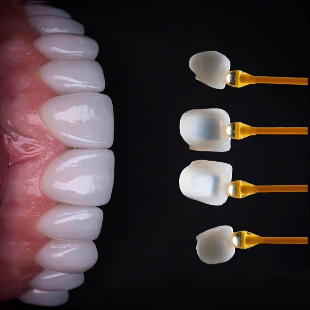 Lamine Veneer (Emax) 3 svg+xml;charset=utf