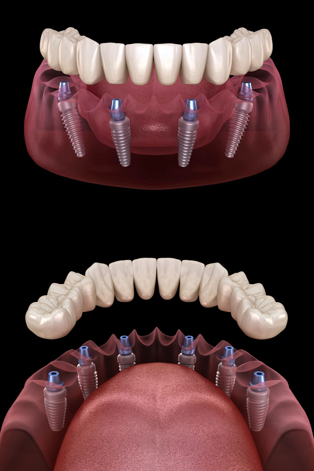 Implant Tedavisi 1 svg+xml;charset=utf