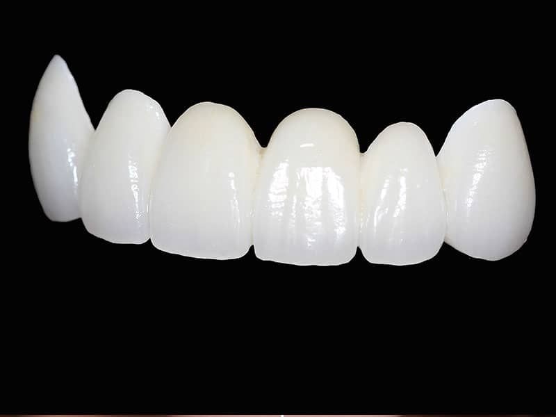 Zirkonyum Diş Kaplama 3 svg+xml;charset=utf