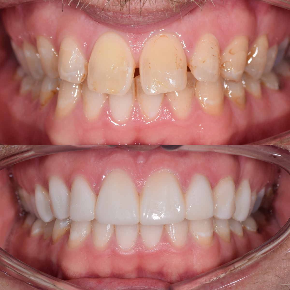 Estetik Dolgu (Bonding) 3 svg+xml;charset=utf