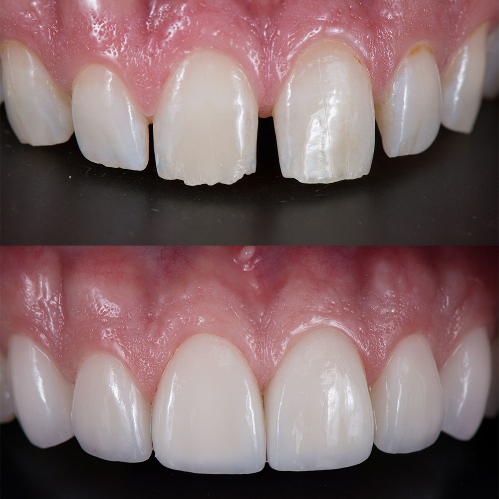 Estetik Dolgu (Bonding) 1 svg+xml;charset=utf