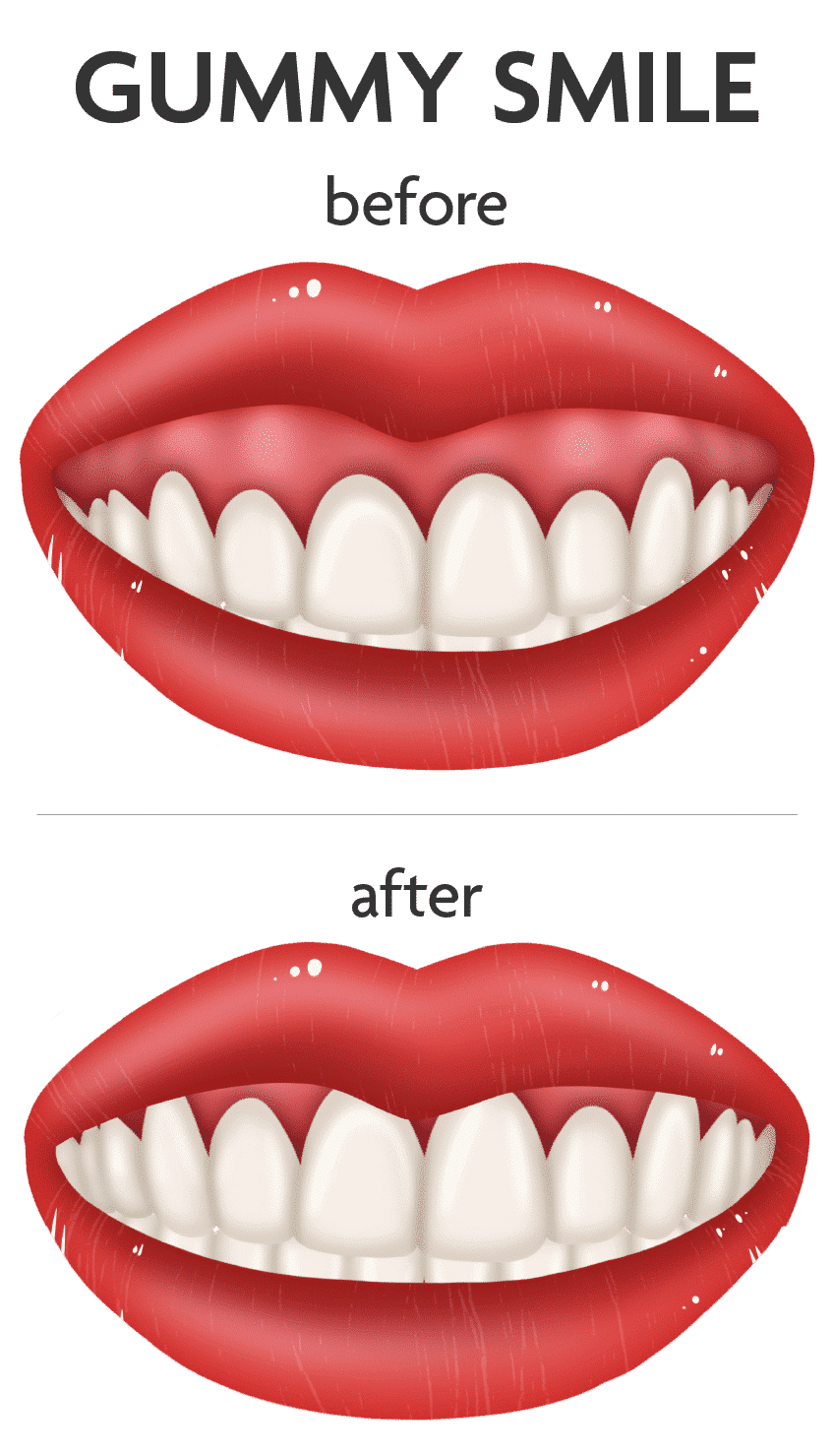 Pembe Estetik (Gummy Smile) 3 svg+xml;charset=utf