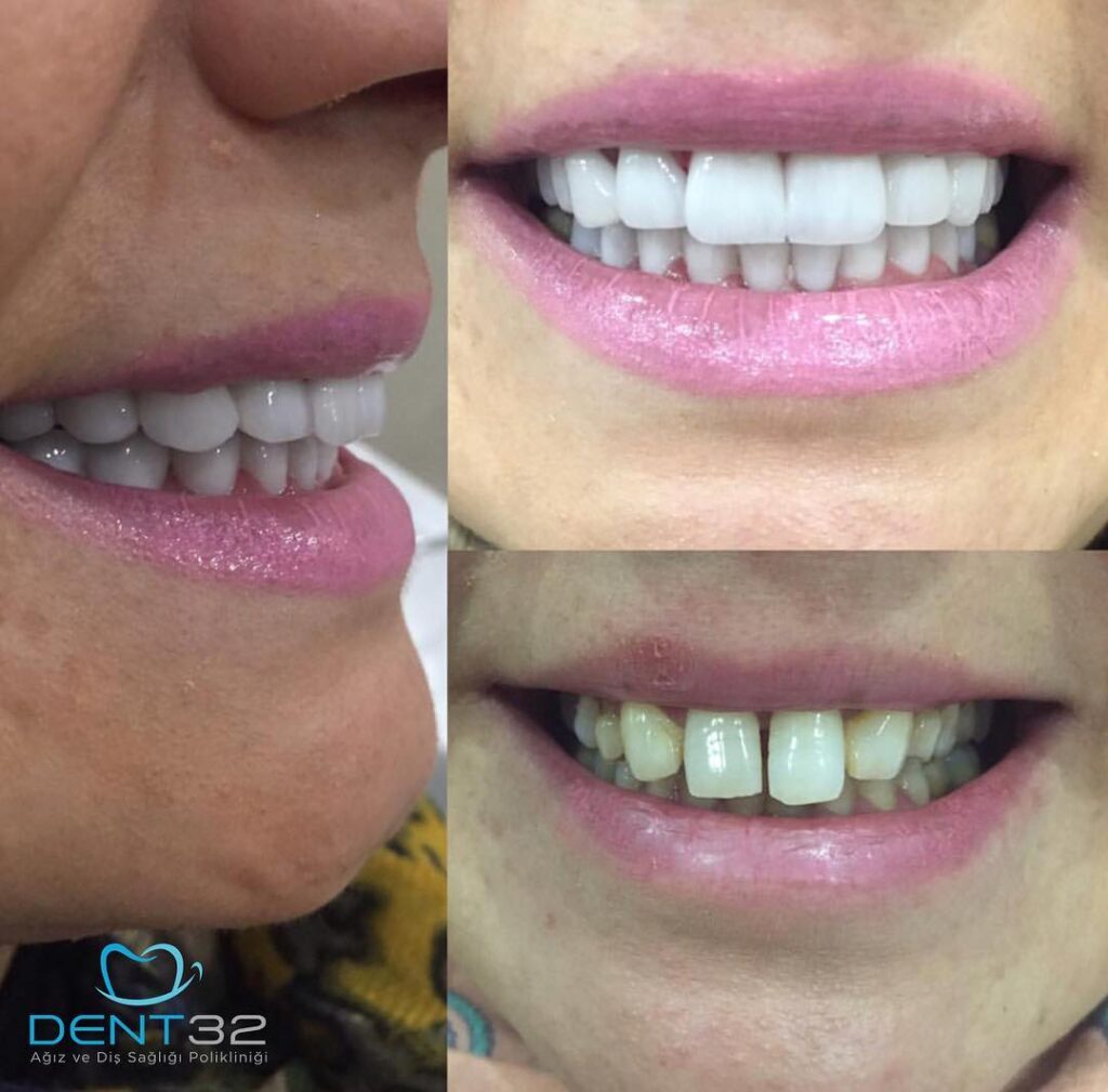 DENT32 BEFORE AFTER (1) svg+xml;charset=utf