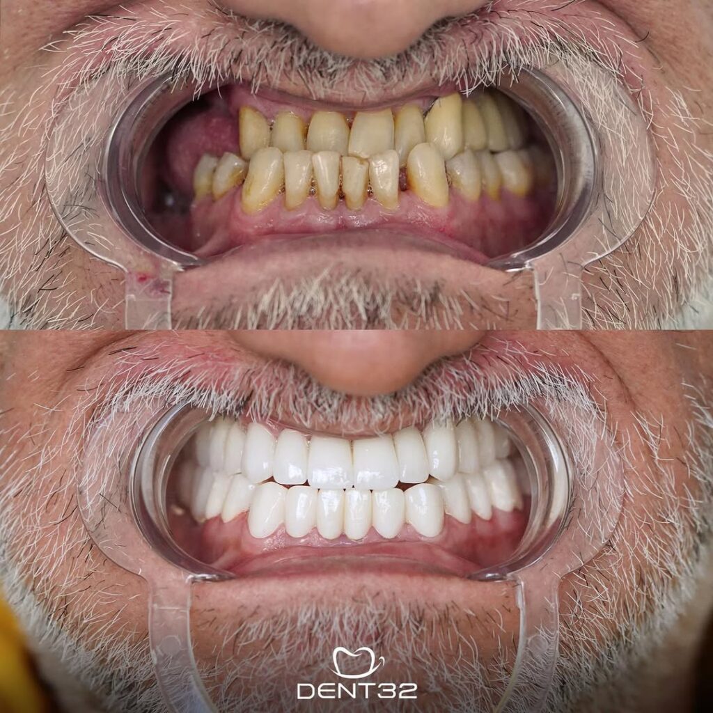 DENT32 BEFORE AFTER (10) svg+xml;charset=utf