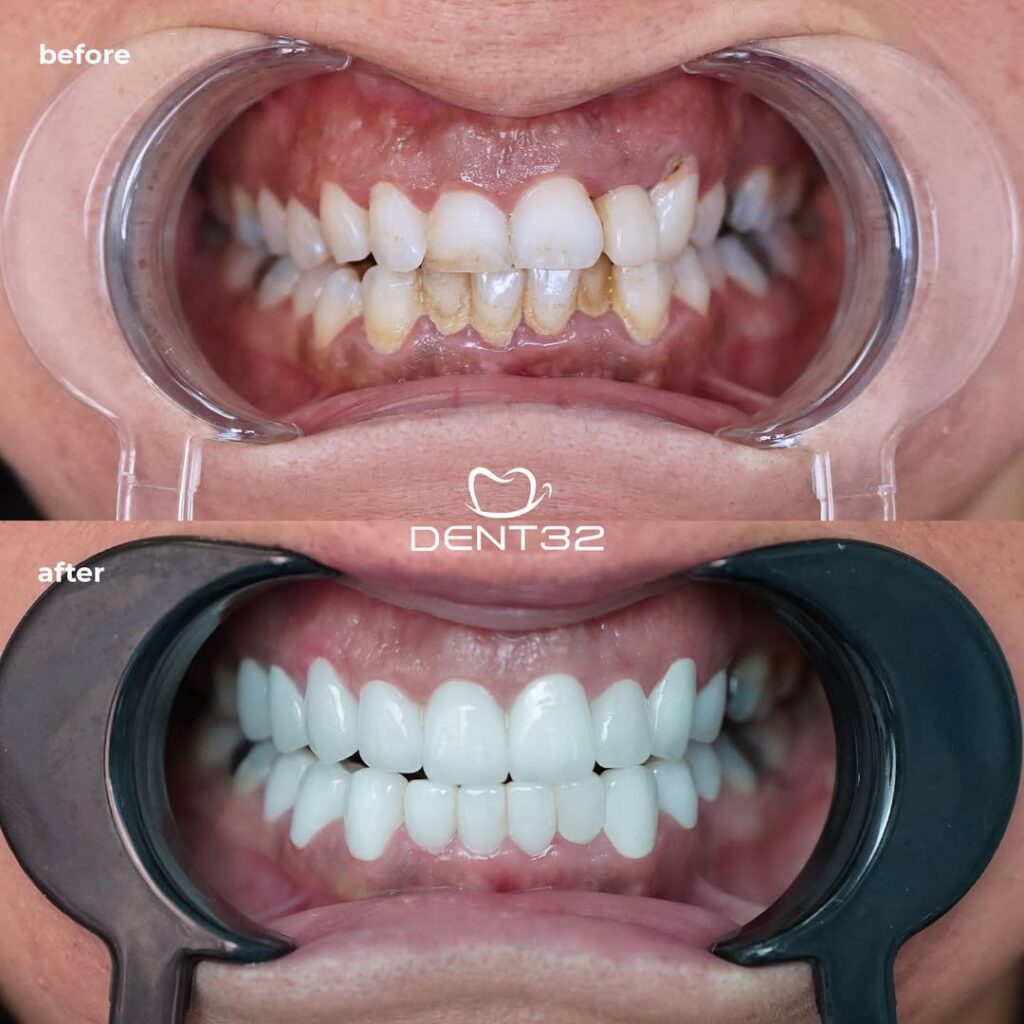 DENT32 BEFORE AFTER (11) svg+xml;charset=utf