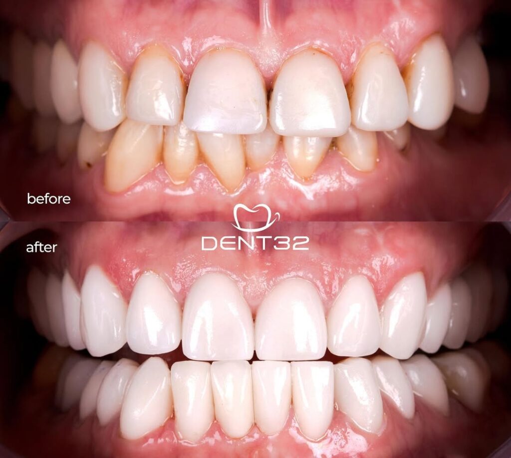 DENT32 BEFORE AFTER (12) svg+xml;charset=utf