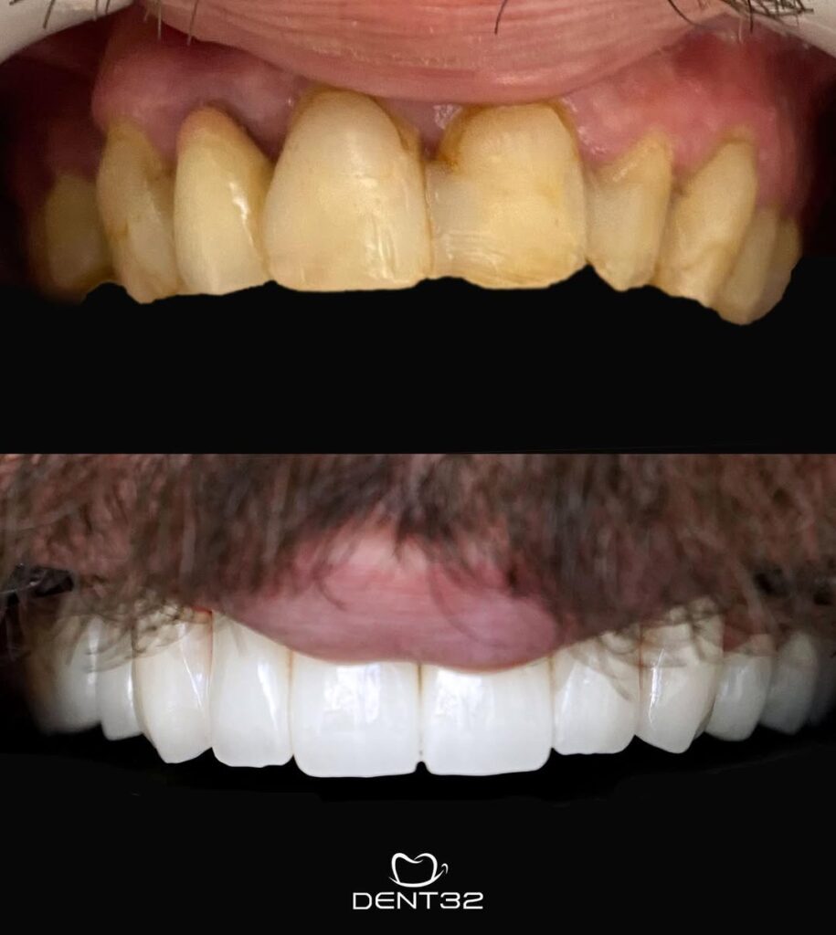 DENT32 BEFORE AFTER (13) svg+xml;charset=utf