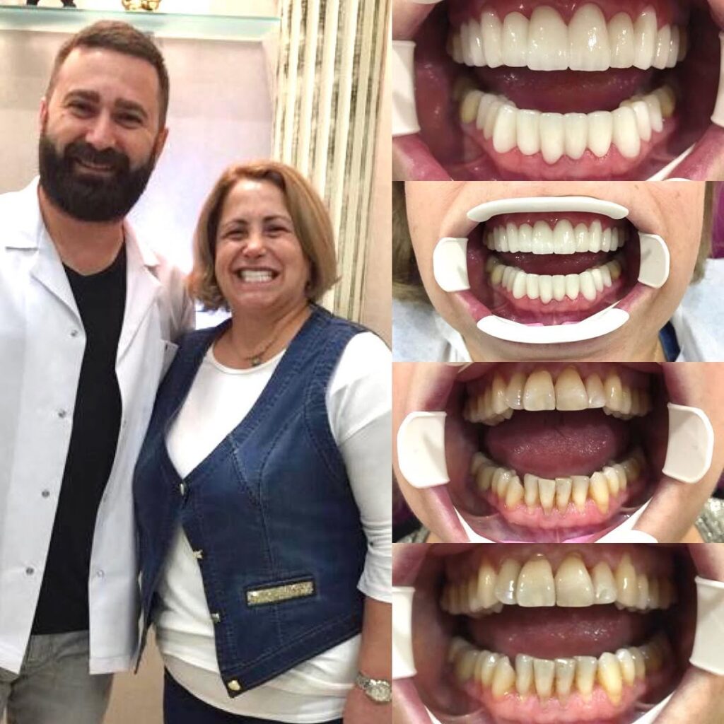 DENT32 BEFORE AFTER (2) svg+xml;charset=utf