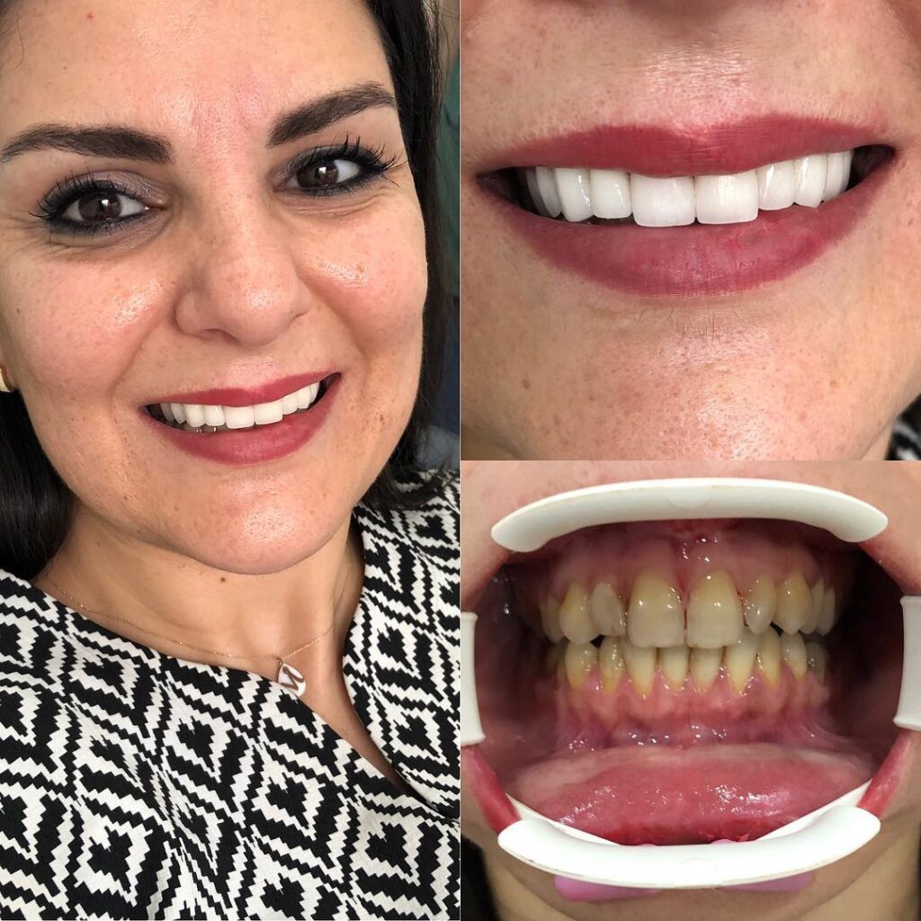 DENT32 BEFORE AFTER (4) svg+xml;charset=utf