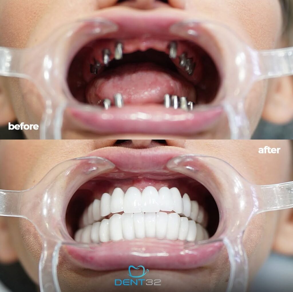 DENT32 BEFORE AFTER (5) svg+xml;charset=utf