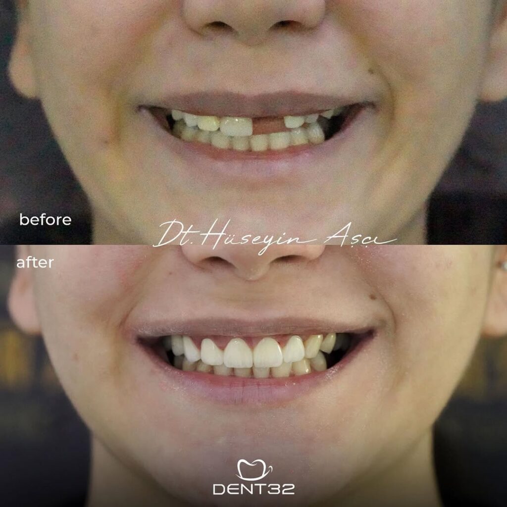 DENT32 BEFORE AFTER (6) svg+xml;charset=utf