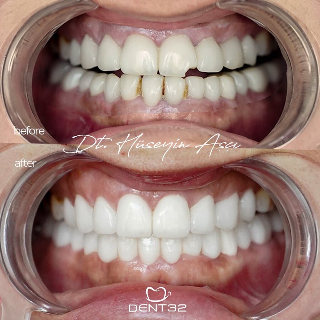 DENT32 BEFORE AFTER (7) svg+xml;charset=utf