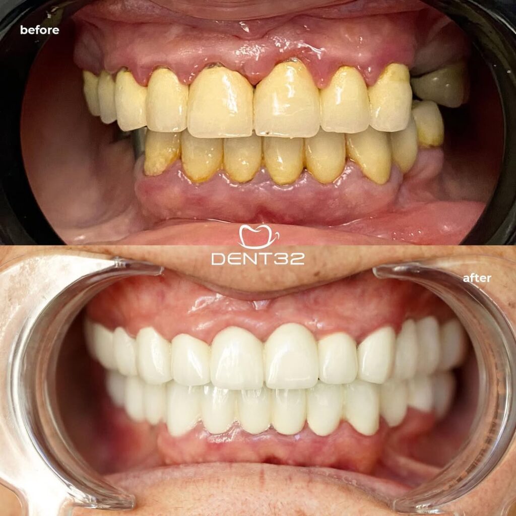 DENT32 BEFORE AFTER (8) svg+xml;charset=utf