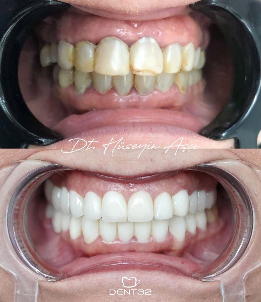 DENT32 BEFORE AFTER (9) svg+xml;charset=utf