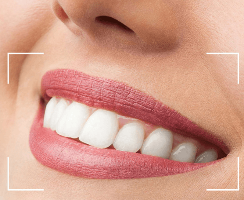Beylikdüzü Dent32 Kliniği’nde Dijital Gülüş Tasarımı ve Hollywood Smile: Hayalinizdeki Gülüşe Kavuşun