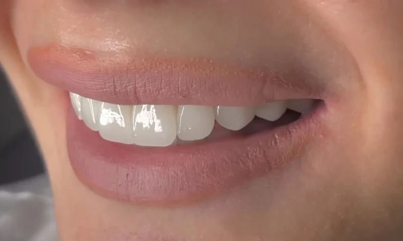 Dijital Gülüş Tasarımı Kimler İçin Uygundur?