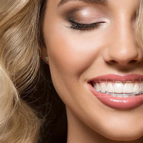 Hollywood Smile Nedir?