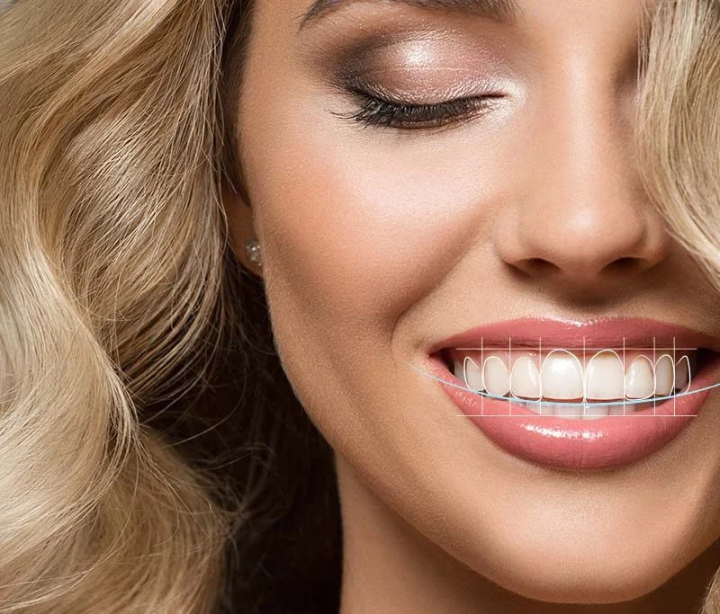 Hollywood Smile Nedir?
