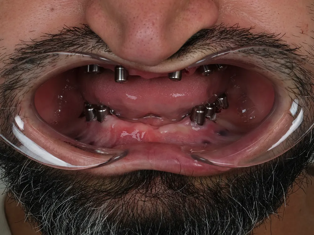 Implant case 1: before treatment