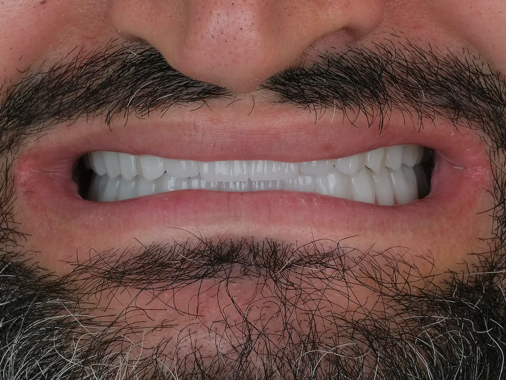 Implant case 1: after treatment