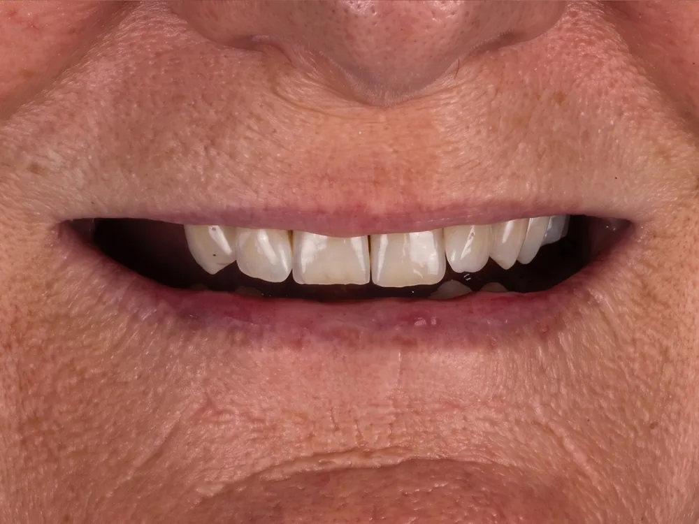 Implant case 2: before treatment