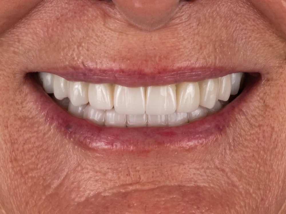 Implant case 2: after treatment