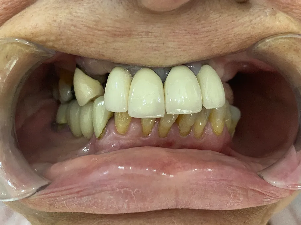 Implant case 3: before treatment