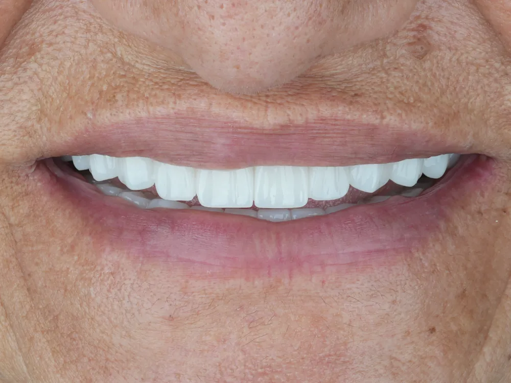 Implant case 3: after treatment