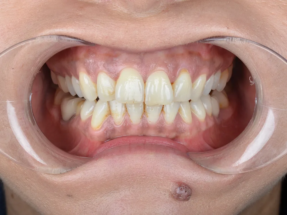 Zirconia case 1: before treatment