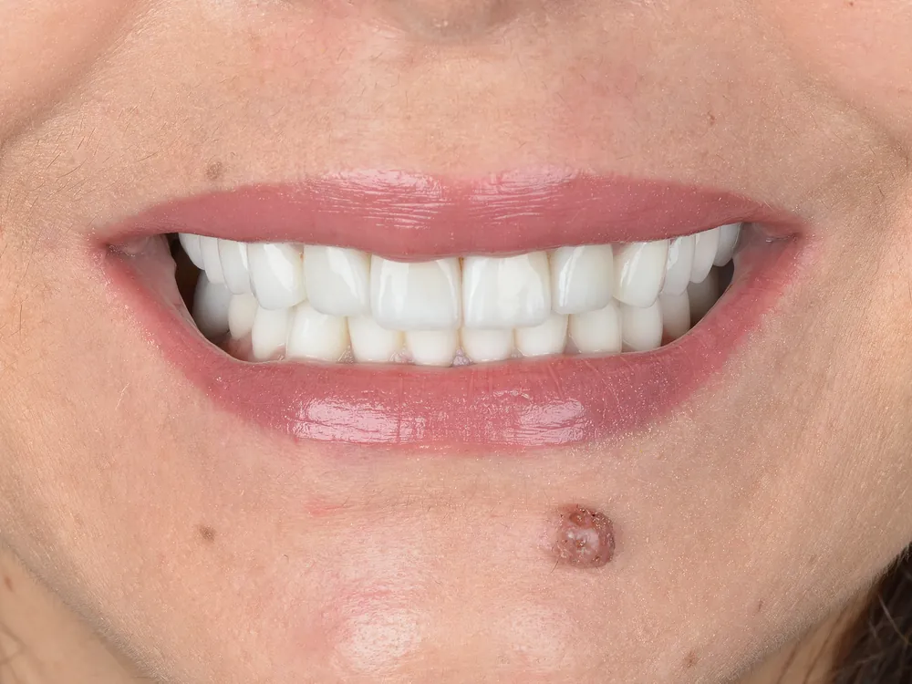 Zirconia case 1: after treatment