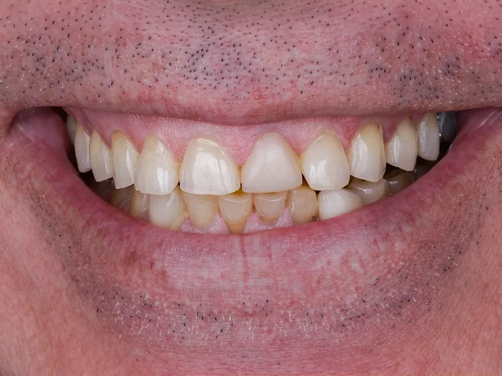 Zirconia case 2: before treatment