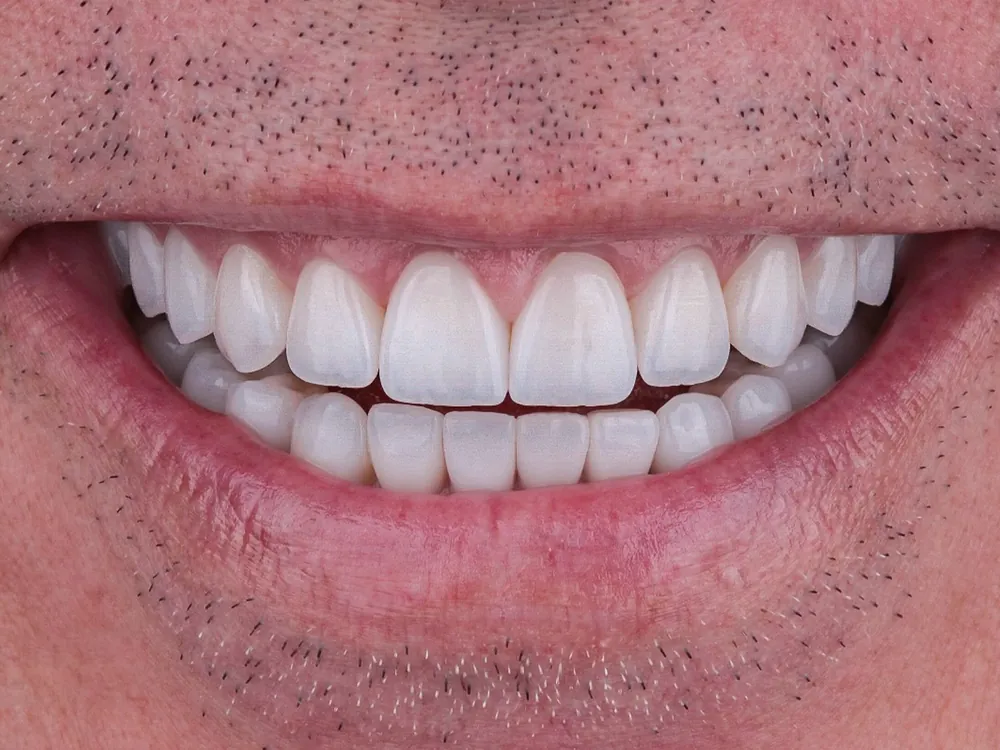 Zirconia case 2: after treatment