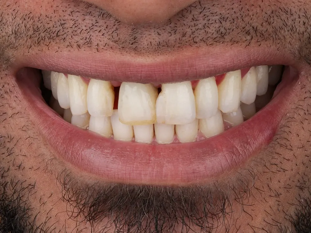 Zirconia case 3: before treatment
