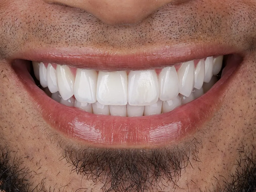 Zirconia case 3: after treatment